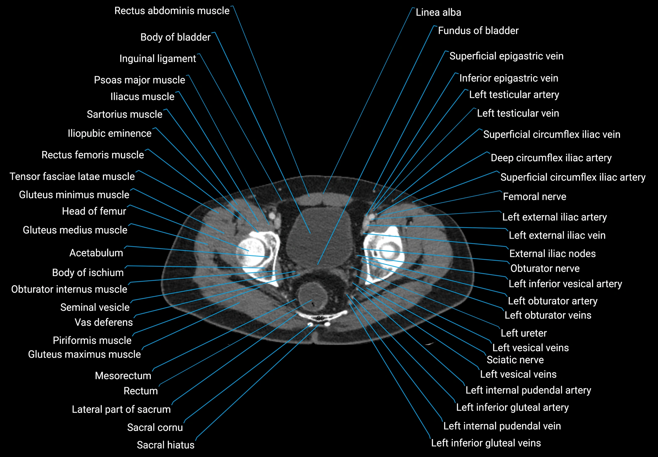 CT male pelvis axial cross sectional anatomy labelled radiology image -00180.webp